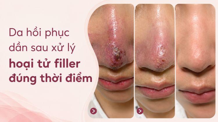 Da hồi phục dần sau xử lý hoại tử filler đúng thời điểm