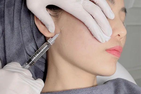Cách xác định điểm tiêm Profhilo theo từng cấu trúc mặt riêng