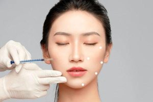 Điểm tiêm Profhilo: Kỹ thuật B.A.P 5 điểm trẻ hóa chuẩn xác
