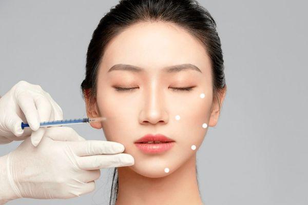 Điểm tiêm Profhilo: Kỹ thuật B.A.P 5 điểm trẻ hóa chuẩn xác