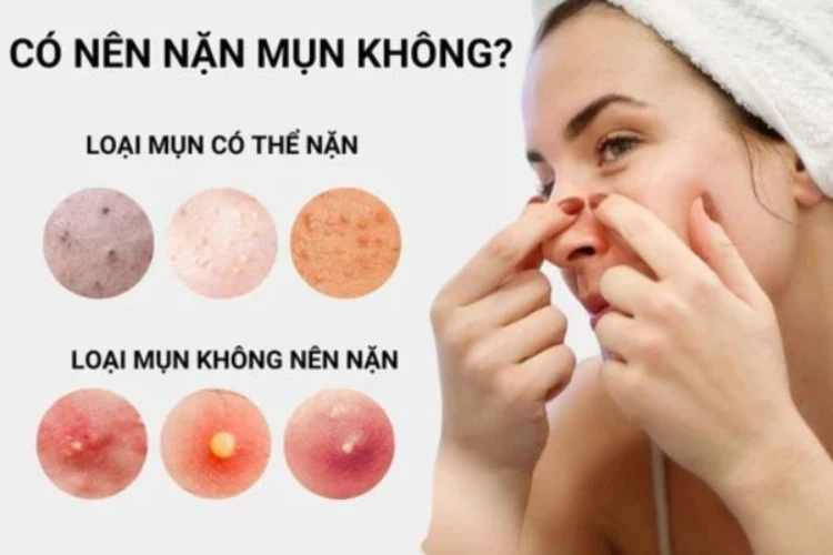 Giải đáp thắc mắc liệu có nên nặn mụn không
