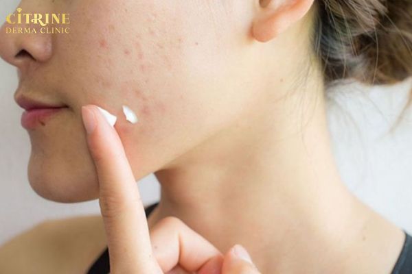 Da bong vảy, hình thành da non và có thể chăm sóc lại nhẹ nhàng