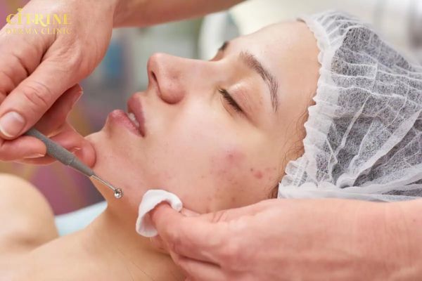 Điều trị chuyên sâu tại phòng khám giúp xử lý mụn cằm và ngừa tái phát