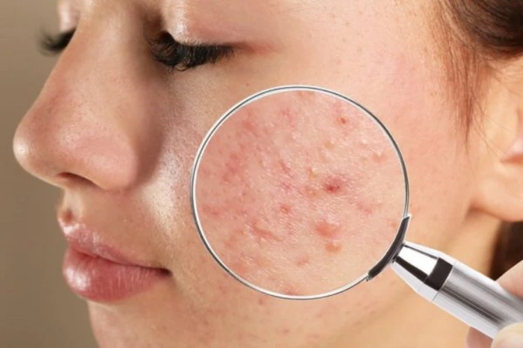 Giới thiệu sơ lược về tình trạng mụn ẩn trên da