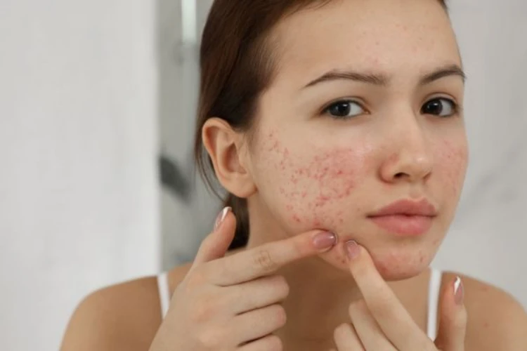 Hình ảnh mụn nội tiết và cách những dấu hiệu nhận biết