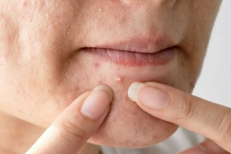 Hướng dẫn nặn mụn đúng cách theo từng trường hợp