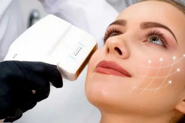 Ultherapy cho hiệu quả nâng cơ rõ rệt, duy trì lâu hơn HIFU