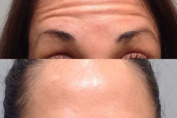 Hiệu quả botox xóa nhăn trán rõ rệt sau 7–14 ngày