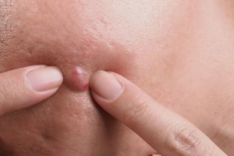 Làm sao để điều trị mụn bị chai cứng dưới da?