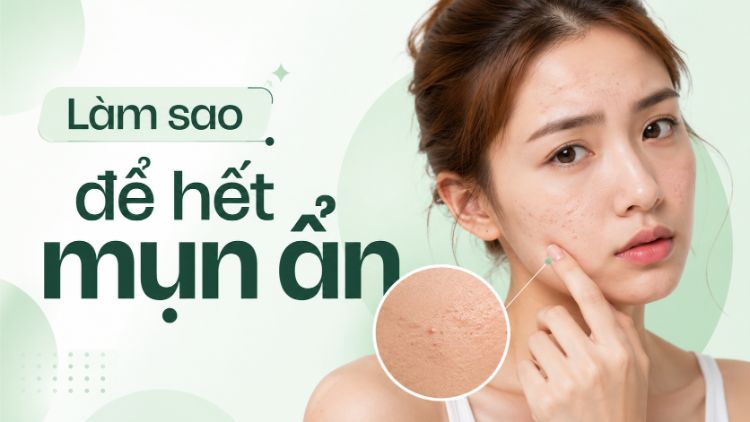 Làm sao để hết mụn ẩn