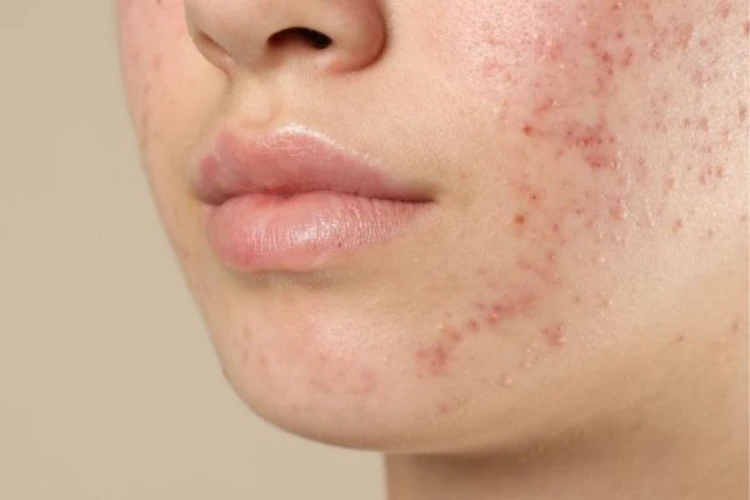 Làm sao để hết mụn ẩn