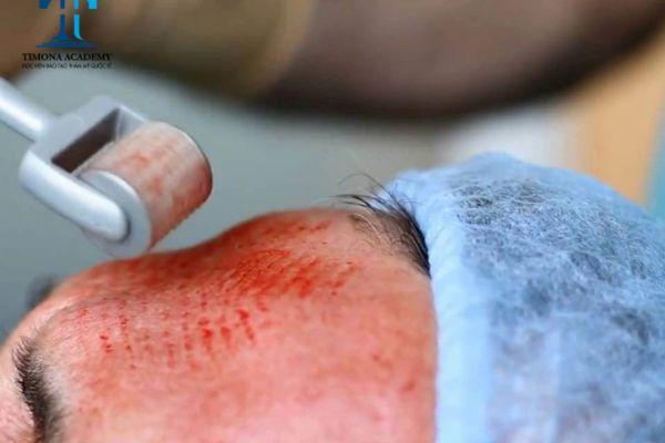 Ưu điểm và rủi ro khi dùng thủ thuật lăn kim