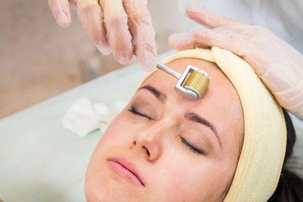 5 bước điều trị sẹo bằng lăn kim tại Citrine