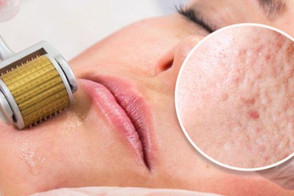 Lăn Kim Trị Sẹo Bao Lâu Thì Mới Thấy Hiệu Quả Rõ Rệt?