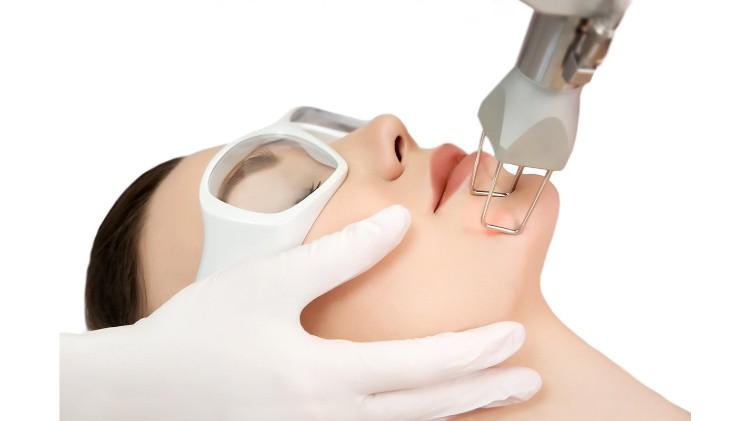 Laser CO2 Fractional: Đột phá trong trị sẹo rỗ và trẻ hóa da