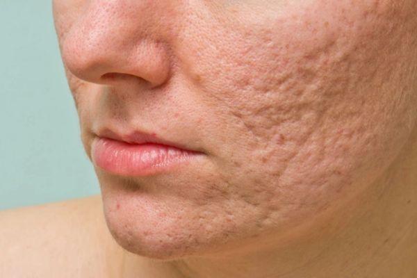 Sẹo rỗ do đứt gãy collagen, cần can thiệp chuyên sâu