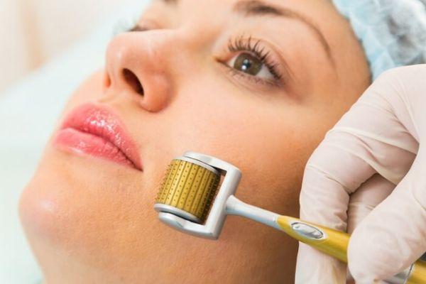 Lăn kim kích thích collagen, cải thiện sẹo và cấu trúc da
