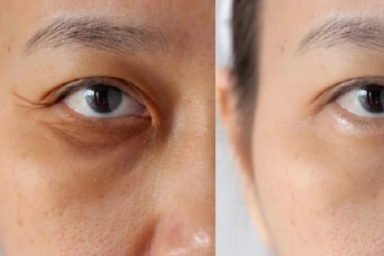 Botox xóa nhăn đuôi mắt giúp làm mờ nếp nhăn tự nhiên, nhanh chóng