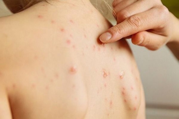 Lưu ý điều gì để xử lý triệt để mụn lưng?