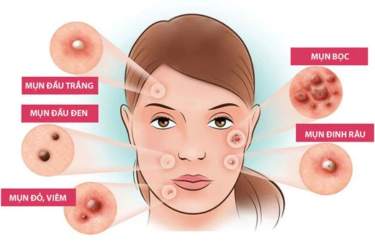 Lưu ý quan trọng để nặn mụn an toàn và ít tổn thương da