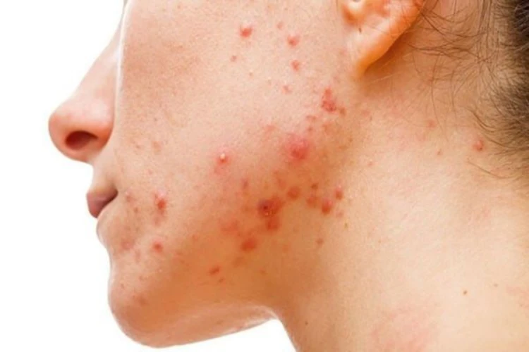 Lưu ý quan trọng về vị trí mụn mọc trên da