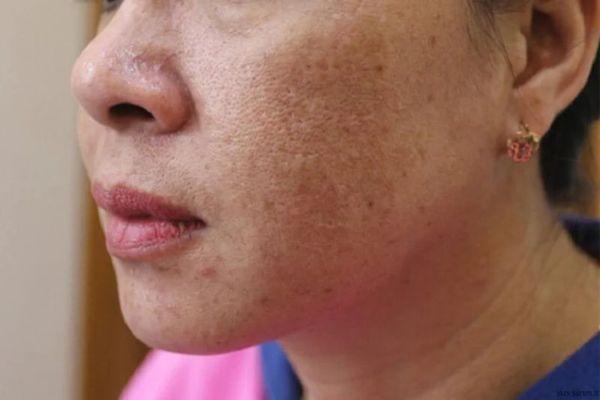 Định nghĩa nám da mặt và cơ chế hoạt động chính
