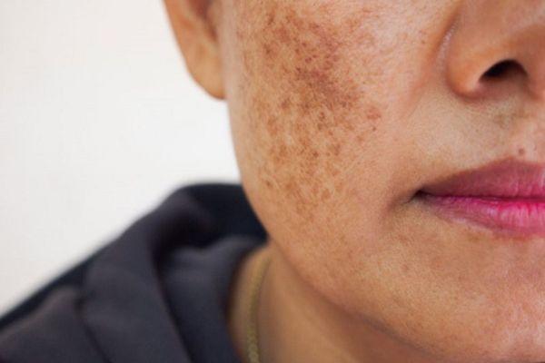 Lý do mặt gặp phải tình trạng nám da là gì?