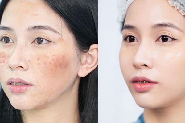 Citrine cũng có phác đồ điều trị nám hiệu quả cho khách hàng