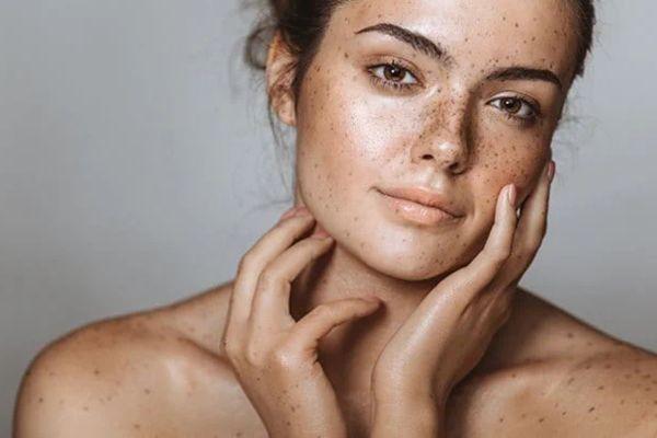 Mặt Bị Nám - Hướng Dẫn Chăm Sóc Da Đúng Cách Mỗi Ngày