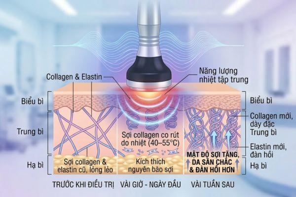 RF kích thích tăng sinh collagen mới, giúp da săn chắc dần theo thời gian