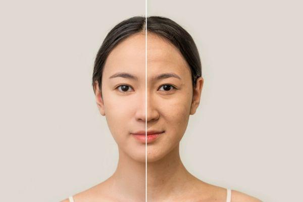 RF nâng cơ giúp săn chắc da, giảm nhăn và trẻ hóa không xâm lấn