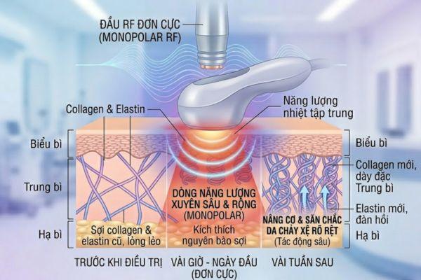 RF đơn cực tác động sâu, hiệu quả cao cho da chảy xệ rõ rệt