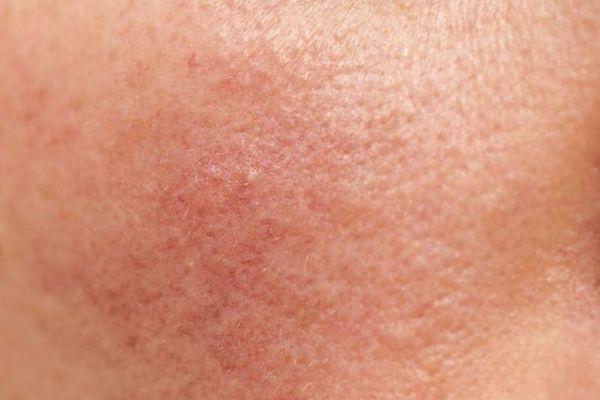 RF nâng cơ có thể gây đỏ, nóng, sưng nhẹ nhưng sẽ tự hết