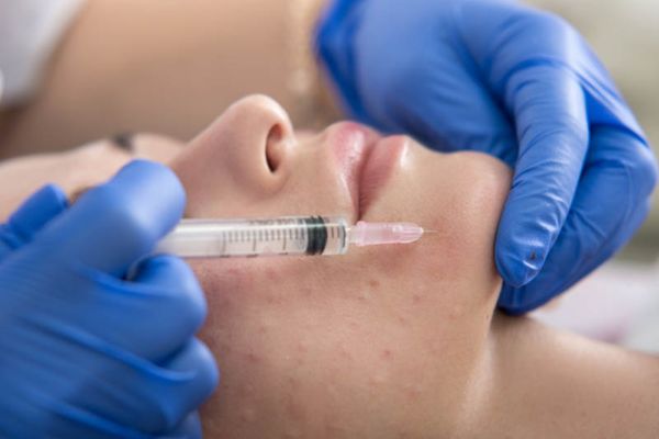 Meso mụn đưa hoạt chất vào trung bì giúp kiểm soát viêm và dầu nhờn hiệu quả