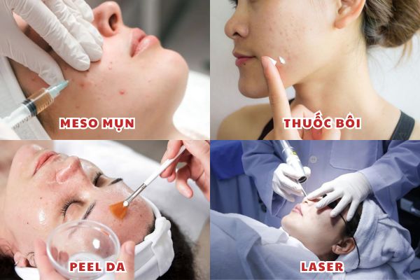 Meso mụn tác động sâu, phù hợp mụn viêm vừa và da dầu tái phát