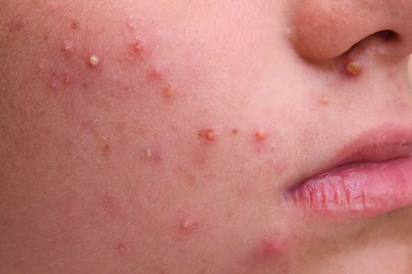 Meso trị mụn phù hợp da dầu, mụn viêm vừa và mụn tái phát