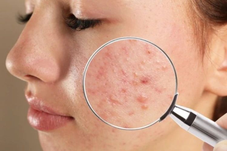 Mụn ẩn là các nốt nhỏ dưới da khiến bề mặt trở nên sần và kém mịn
