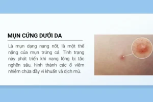 Mụn bị chai cứng dưới da phải làm sao