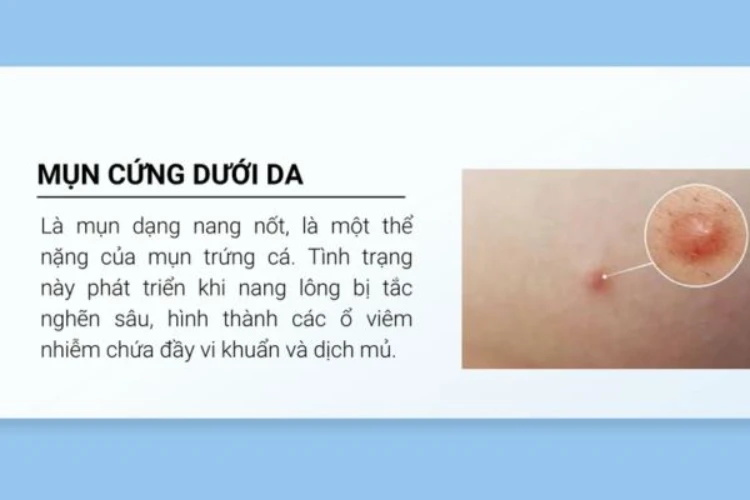 Mụn bị chai cứng dưới da phải làm sao