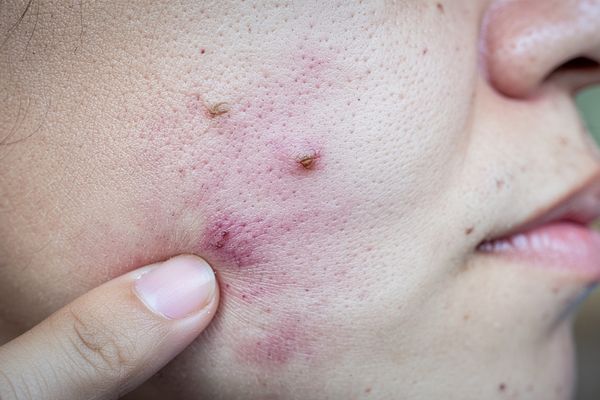 Mụn bọc có thể tự xẹp được hay không?