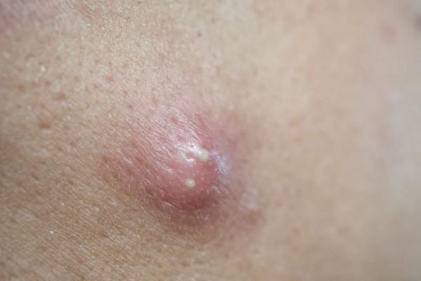 Mụn bọc là dạng mụn viêm sâu, sưng to và gây đau nhiều