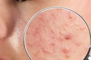 Mụn cám là gì
