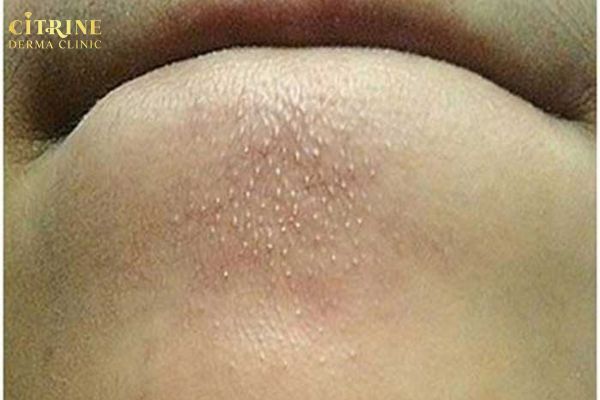 Mụn đầu trắng và đầu đen ở cằm dễ tiến triển thành mụn viêm