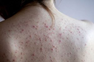 Mụn lưng do đâu