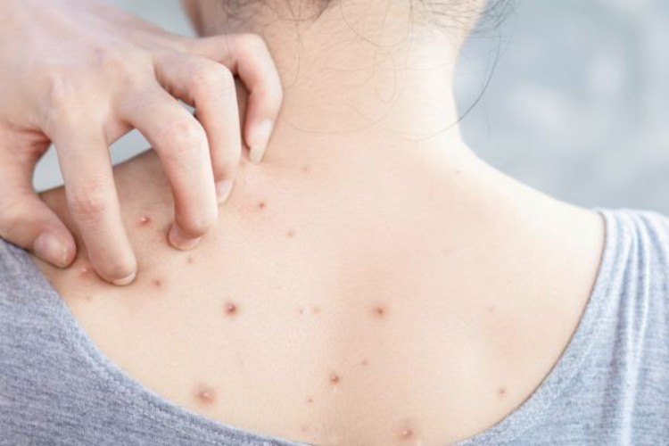 Mụn lưng do đâu và những nguyên nhân từ gốc rễ