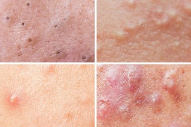 Mụn nhẹ thì nên điều trị thế nào cho an toàn?