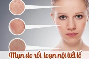Mụn nội tiết là gì