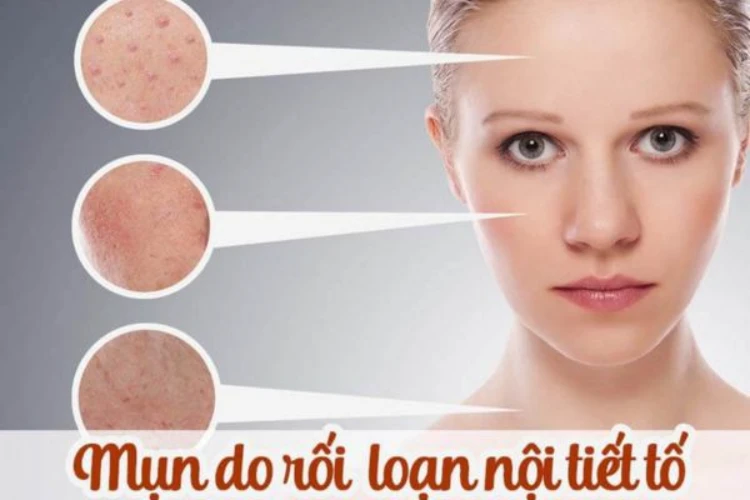 Mụn nội tiết là gì
