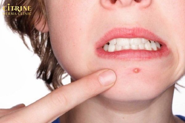Mụn ở cằm dễ nhận biết qua đau nhẹ sưng đỏ và nổi mụn viêm