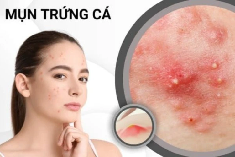 Mụn trứng cá